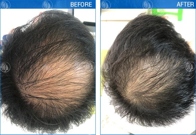 Rụng tóc của bạn thuộc nhóm nào — dấu hiệu nào cần đi khám ngay?