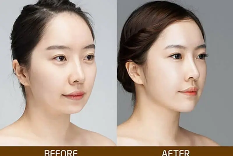 Phương pháp phù hợp: filler cằm, độn cằm implant, cấy mỡ và căng chỉ
