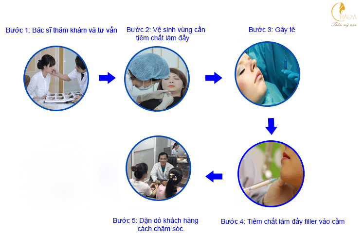 Chi phí độn cằm và số lần cần làm — nên lên kế hoạch thế nào?