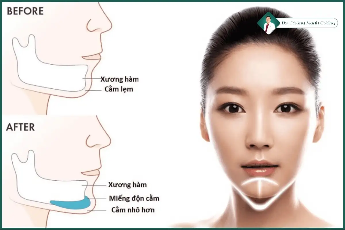 Tiêm filler (Axit hyaluronic)
