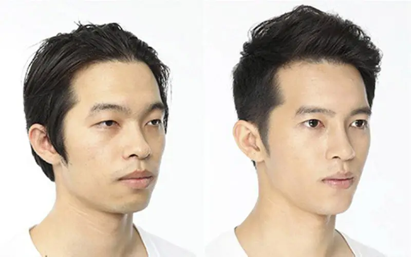 Độn implant (sụn nhân tạo) và trượt cằm (genioplasty)