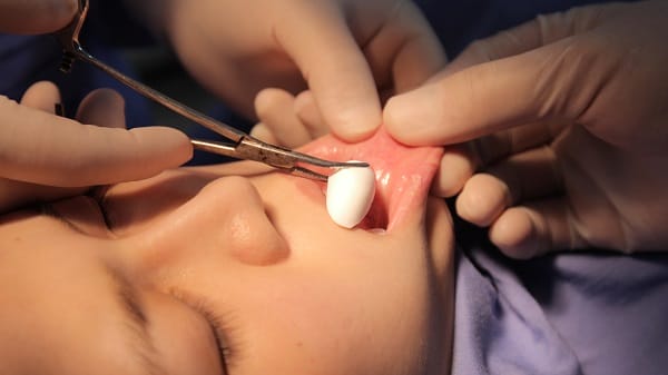 Độn cằm có an toàn không — lợi ích, rủi ro và ai không nên làm?