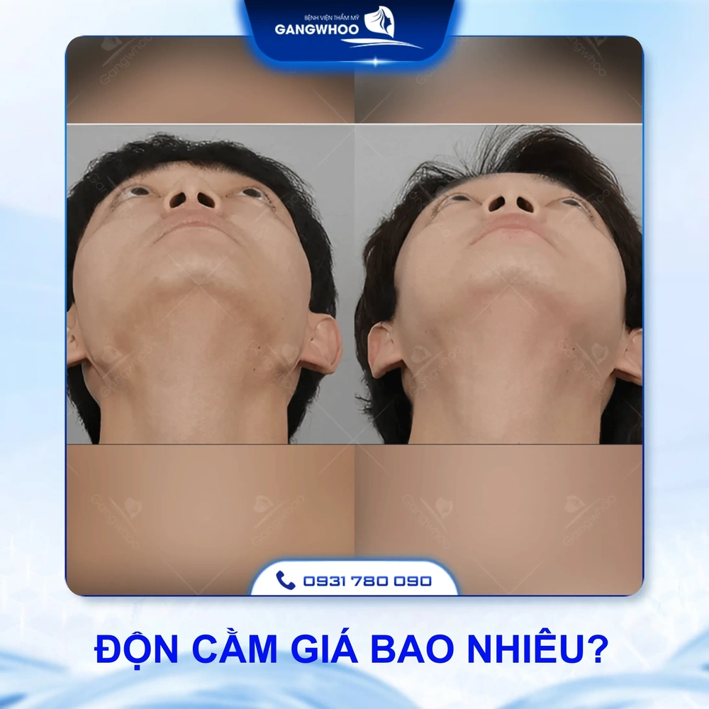 Quy trình một ca độn cằm an toàn — cần chuẩn bị và những bước quan trọng