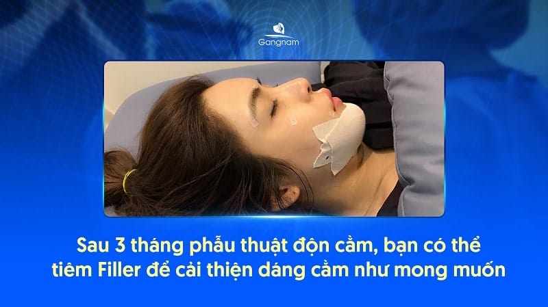 Những lưu ý chăm sóc sau khi tiêm filler vùng cằm đã đặt implant