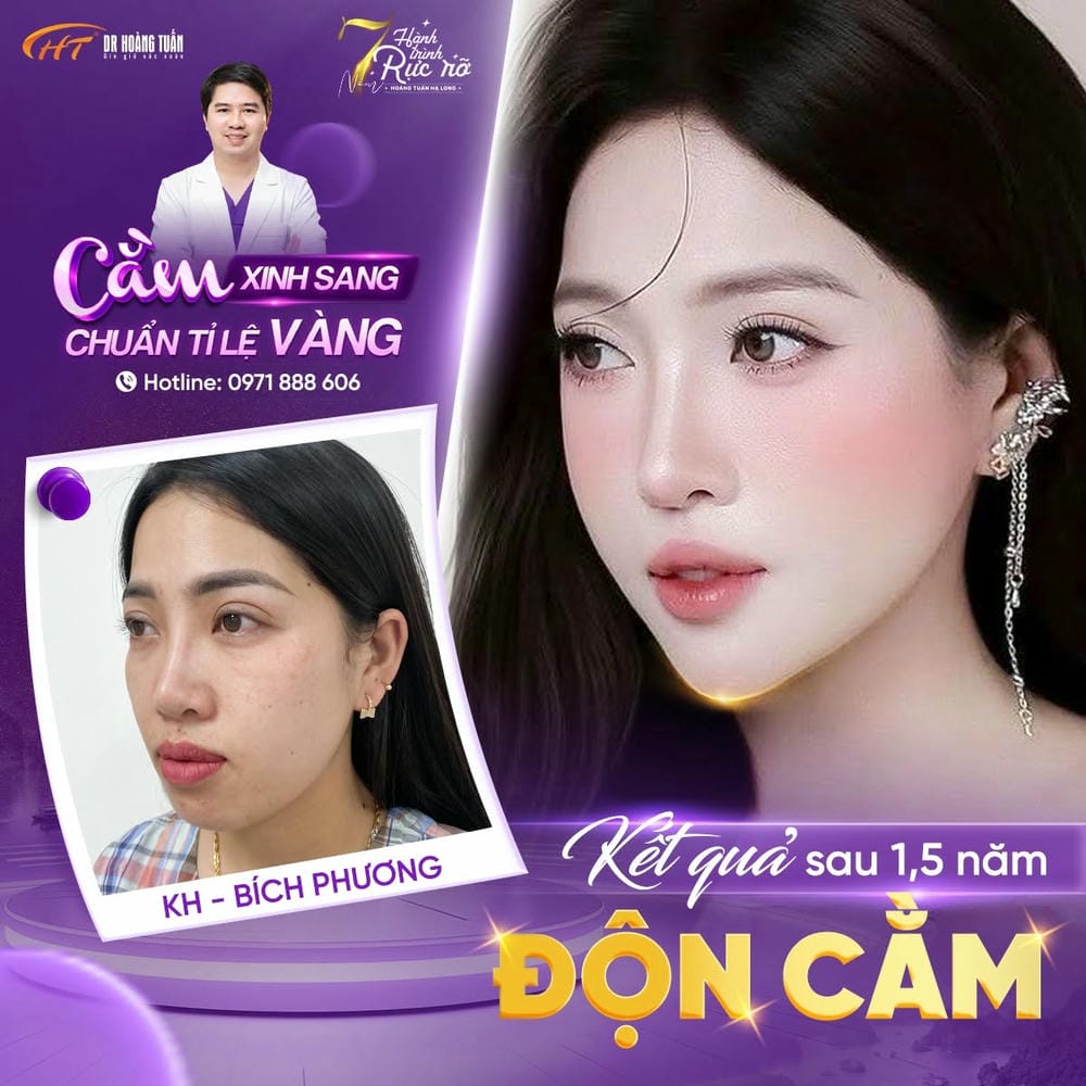 Tiêm độn cằm bằng filler thì hiệu quả duy trì bao lâu và khi nào cần chích lại?