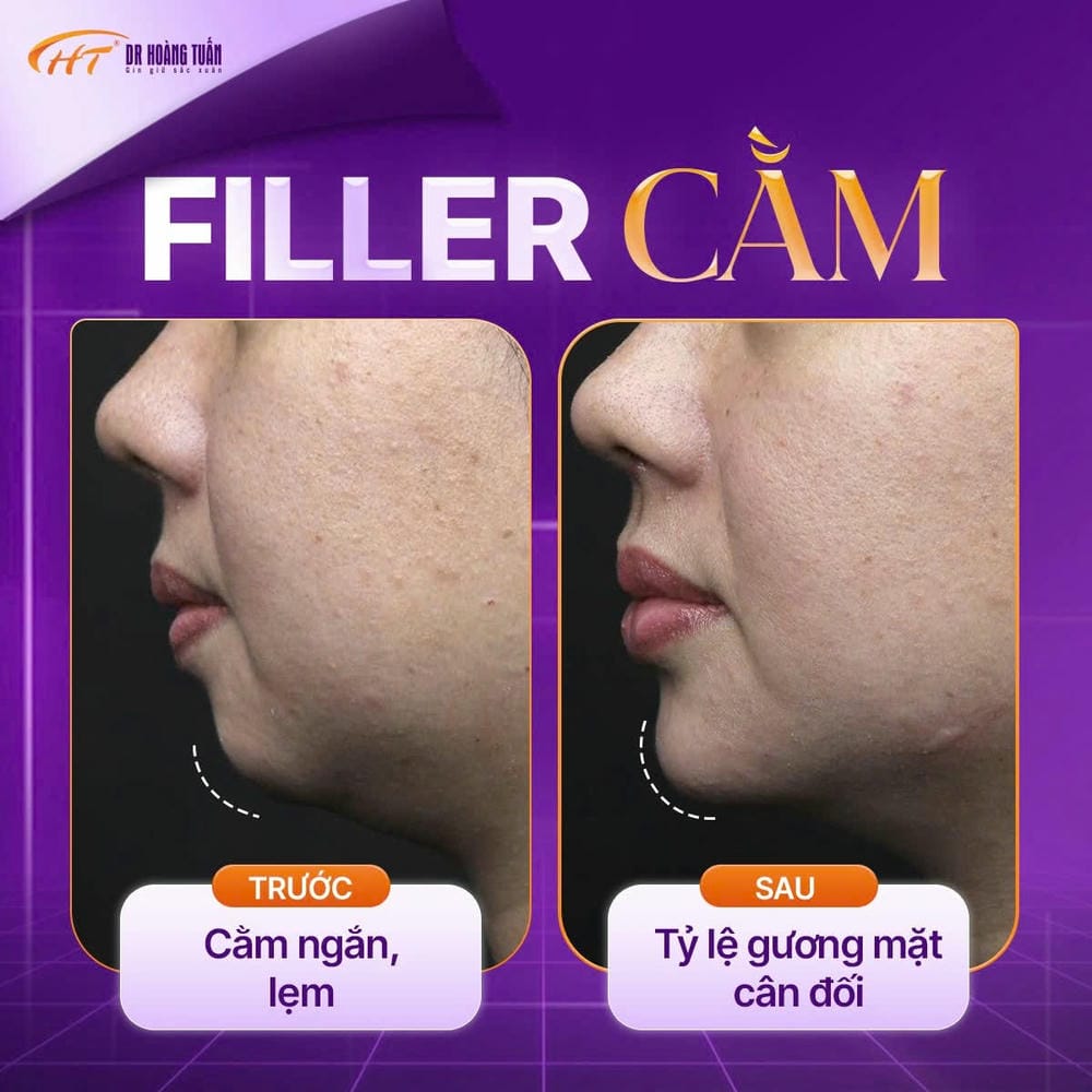 Chăm sóc sau tiêm độn cằm — cần lưu ý ngay sau và trong 7–14 ngày