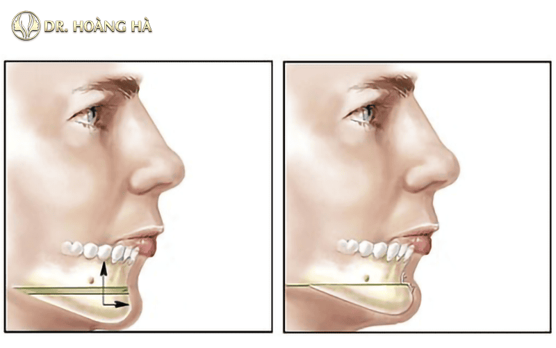 Tiêm filler hay đặt implant cằm — phương pháp nào phù hợp với tình trạng của bạn?