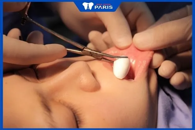Chi phí, loại filler cằm HA và cách chọn sản phẩm an toàn tại Việt Nam?