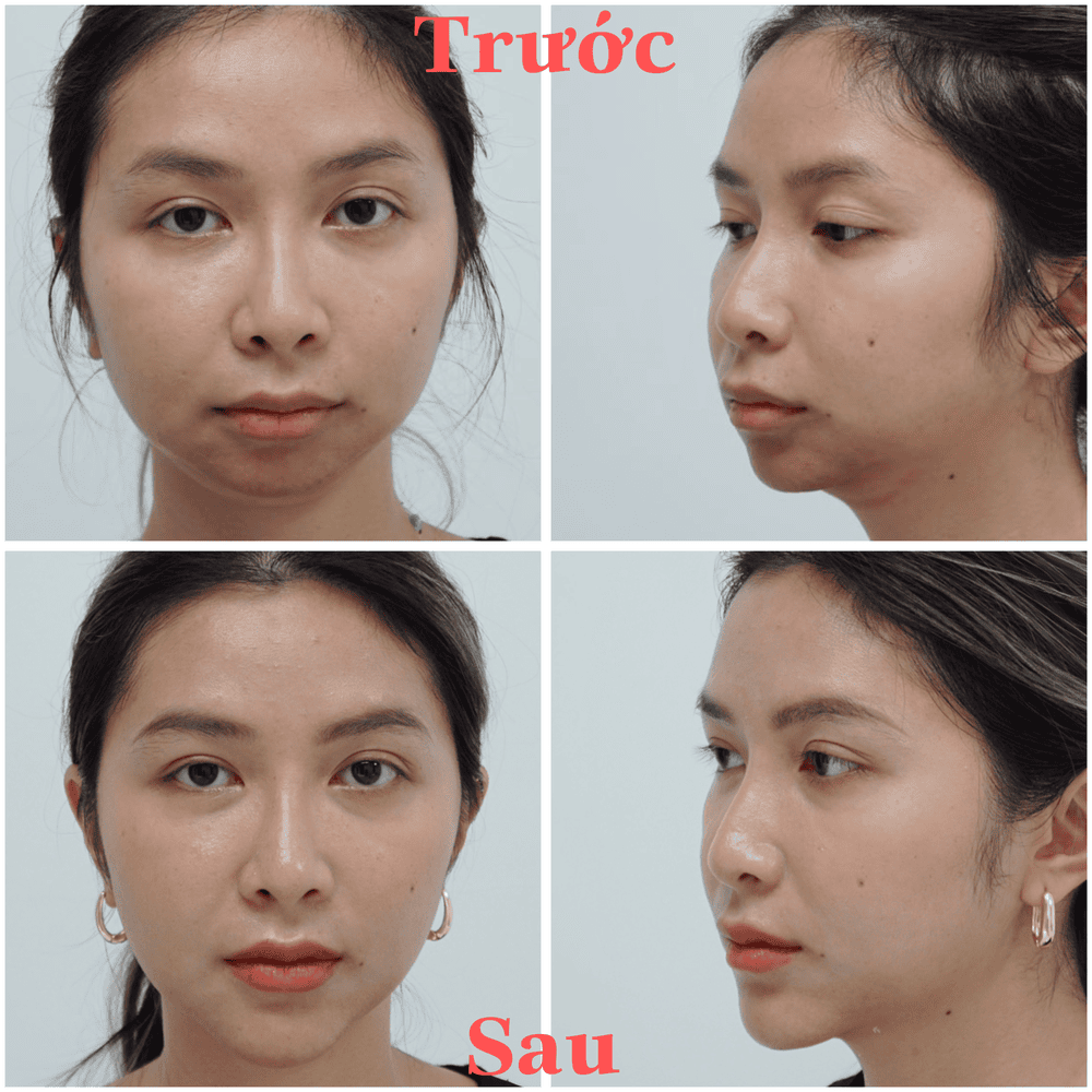 Vai trò của botulinum toxin trong chỉnh cằm?