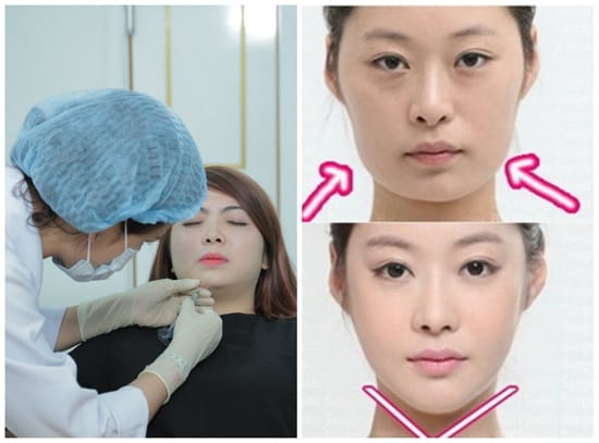 Các bước trước, trong và sau thủ thuật (mẫu chung)