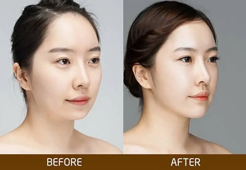 Độn cằm V-line: Phương pháp nào thực sự phù hợp với khuôn mặt của mình?
