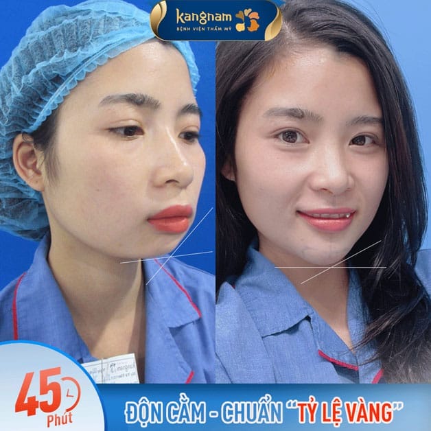 So sánh nhanh: Tiêm filler, đặt implant, bóp góc hàm bằng Botox hay nâng cơ chỉ — ưu và nhược điểm?