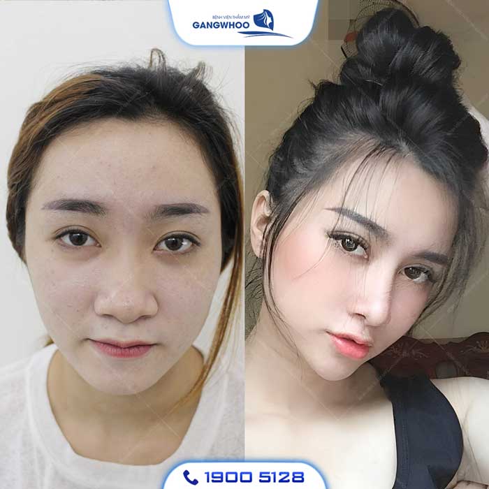Làm sao để chọn nơi độn cằm uy tín và an toàn?