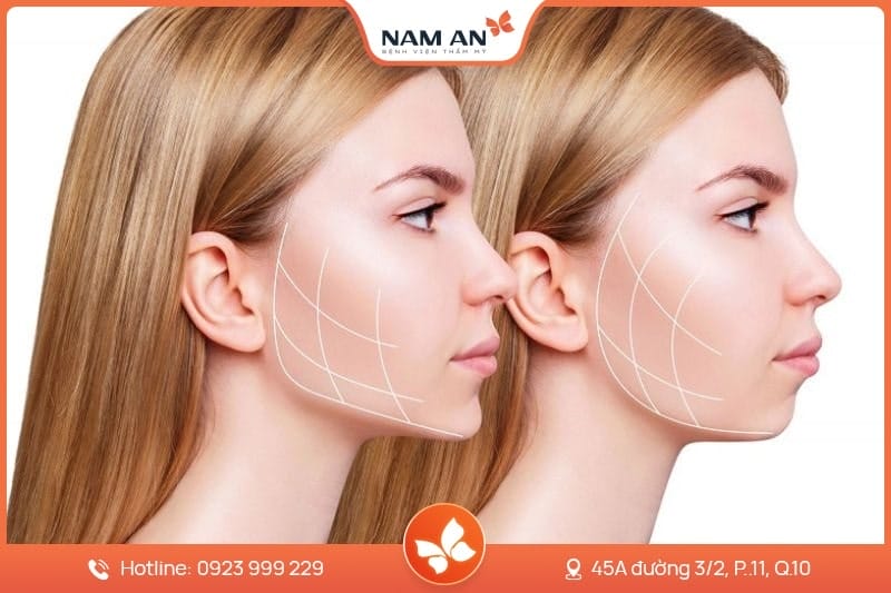 Bảng so sánh các phương pháp tiêm filler cằm, đặt implant cằm và phẫu thuật genioplasty