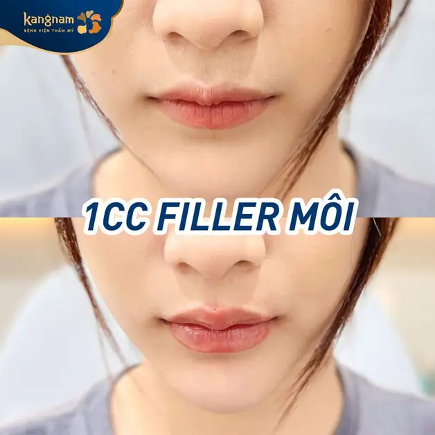 Tiêm filler môi dùng loại filler nào — giá sản phẩm ảnh hưởng thế nào?