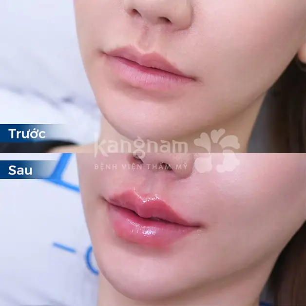 Bệnh lý hoặc thuốc nào làm tăng nguy cơ khi tiêm filler?