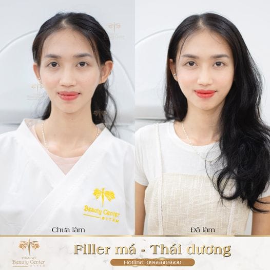 Tiêm filler thái dương được bao lâu trong thực tế?