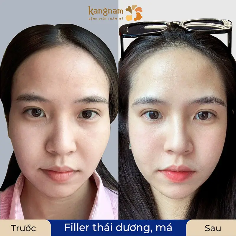 So sánh nhanh: HA, Radiesse và Sculptra cho thái dương — nên chọn thế nào?
