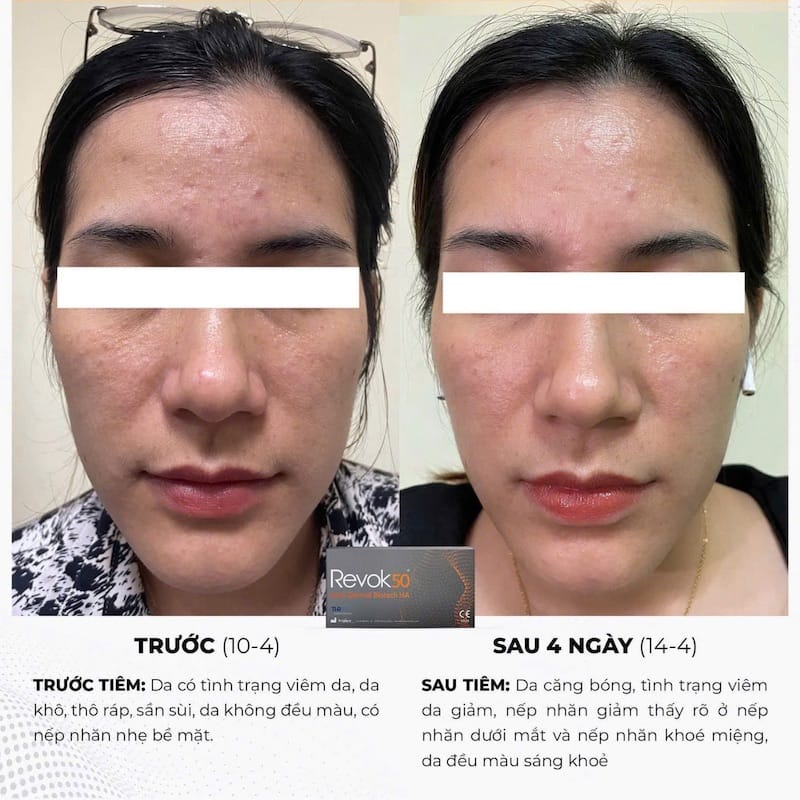 Bác sĩ da liễu tiêm Revok 50: vì sao nên ưu tiên?