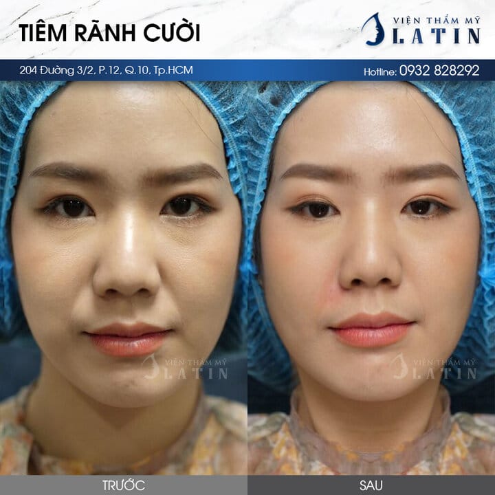 Ngay sau khi tiêm rãnh cười: có cần nhịn cười tuyệt đối?