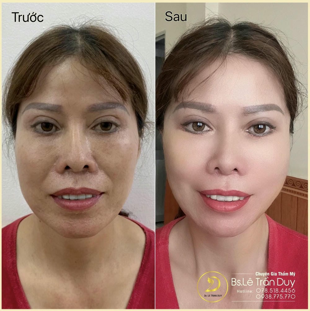 Quy trình và chăm sóc sau tiêm filler rãnh cười