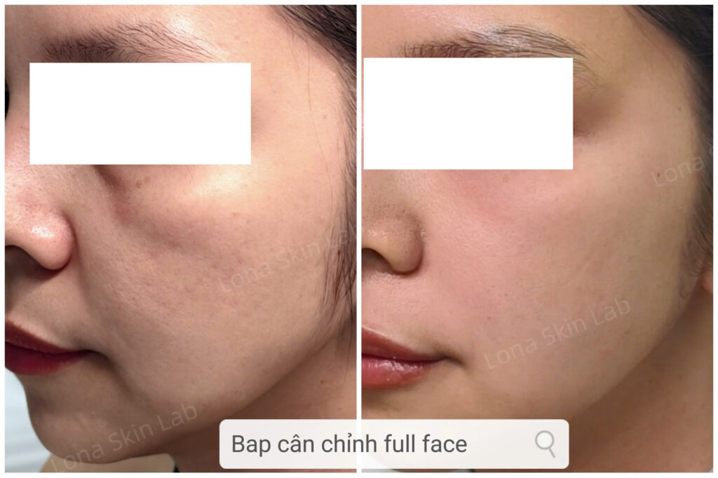 So sánh Meso và Bap, Tiêm Meso, Tiêm BAP, Sự khác biệt giữa Tiêm Meso và Tiêm BAP, Phương pháp trẻ hóa da, So sánh Tiêm Meso và Tiêm BAP