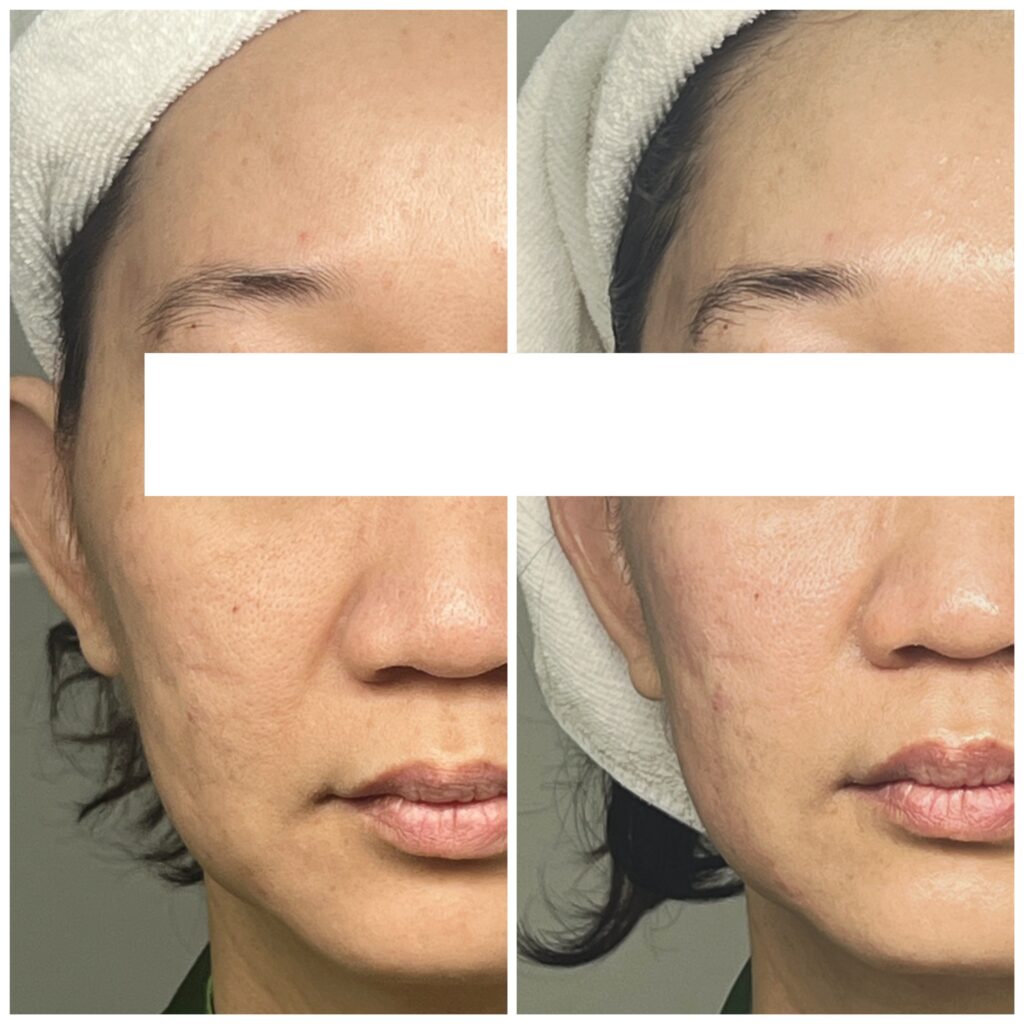 điều trị da đa tầng, điều trị da đa tầng, cấu trúc da, chất lượng mô, lão hóa da, tái tạo da
