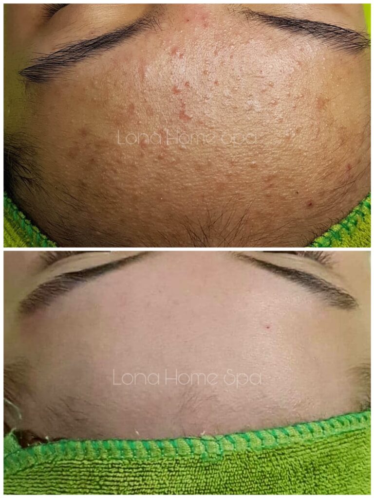 Retinol Juliette Armand, serum phục hồi MartiDerm, da mụn, chăm sóc da mụn, kết hợp Retinol và serum phục hồi