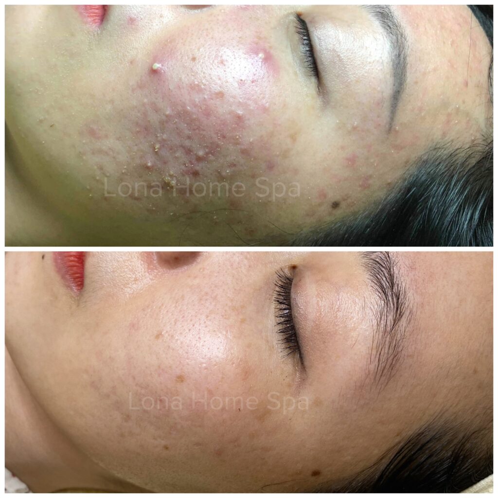 Dermafirm cho da dầu mụn nhạy cảm - minh họa SEO chuyên sâu cho sản phẩm Dermafirm Purifying AC Exosome Lotion