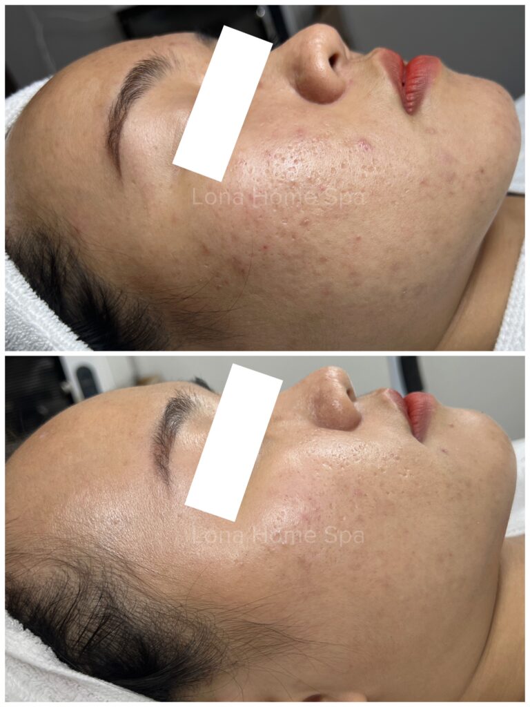sẹo mụn phòng dễ hơn trị, sẹo mụn, phòng sẹo mụn, ngăn ngừa sẹo mụn, mụn viêm, trị sẹo mụn