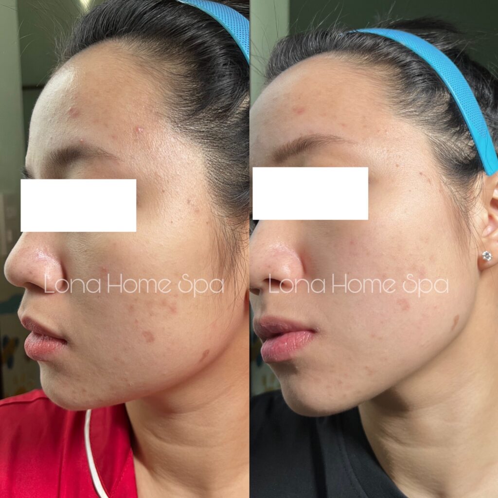thứ tự thoa Niacinamide và BHA