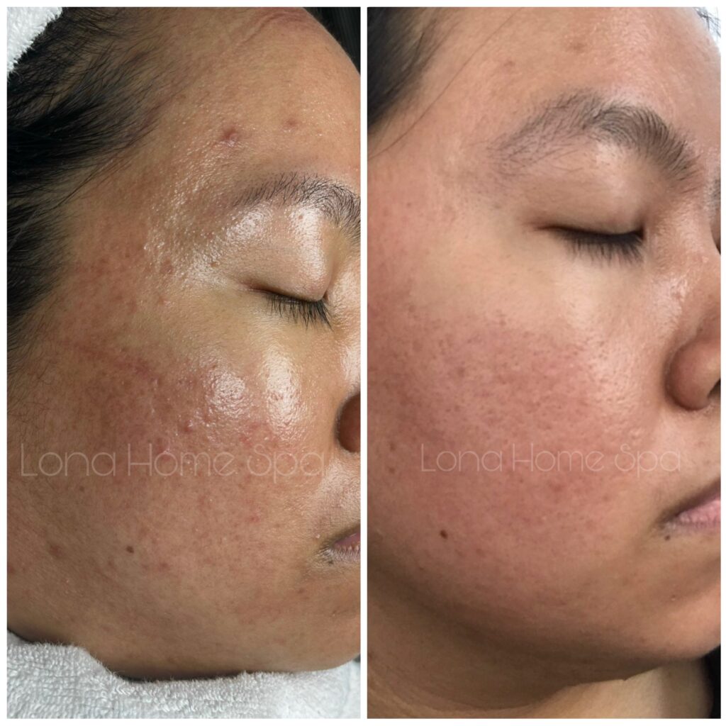 trị nám AiThan, bộ trị nám AiThan, đánh giá bộ trị nám AiThan, trị nám hiệu quả, kem trị nám AiThan, trải nghiệm người dùng AiThan