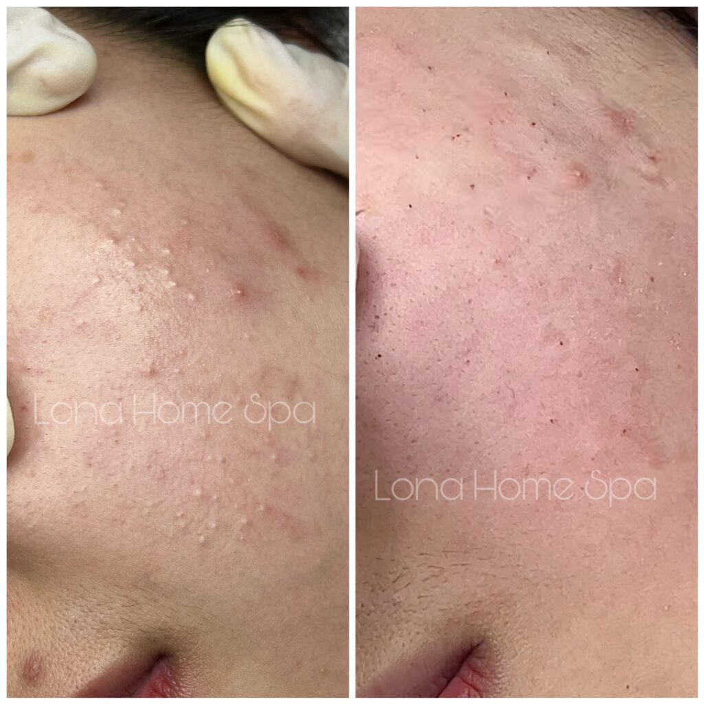 cách sử dụng Niacinamide và BHA