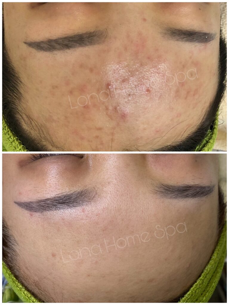 kết hợp Niacinamide và BHA