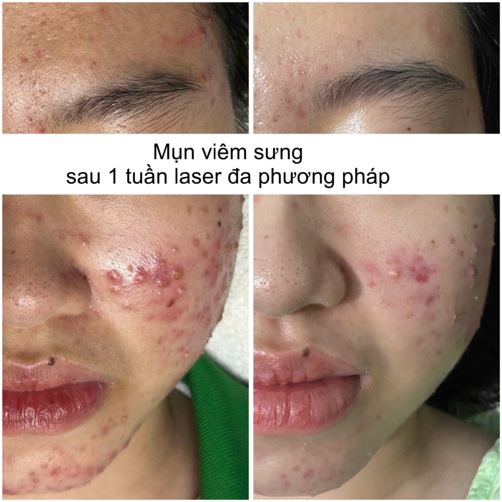 Quá trình xử lý khiếm khuyết sau mụn được ứng dụng hiệu quả thông qua quy trình hậu mụn kỹ lưỡng, hỗ trợ phục hồi da sau mụn, trị sẹo mụn và tái cấu trúc da theo tiêu chuẩn chuyên môn.