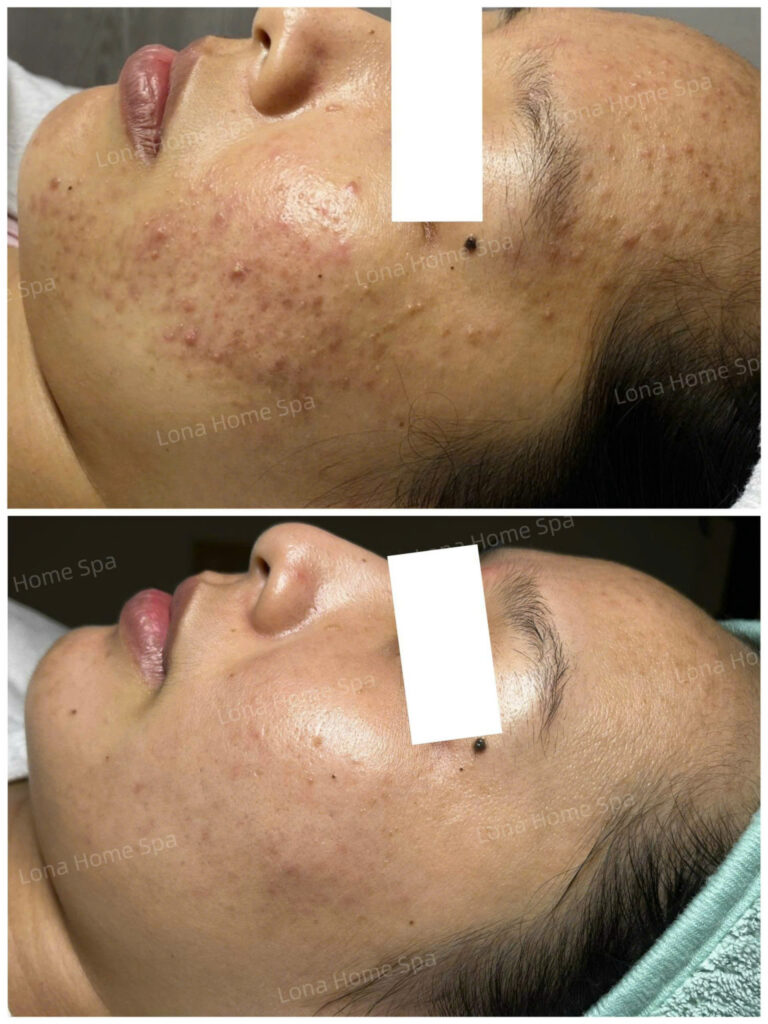 Succinic Acid, Juliette Armand, chăm sóc da mụn, axit succinic, sản phẩm trị mụn