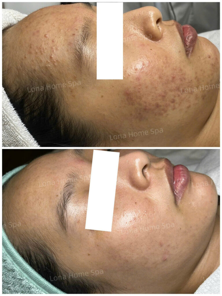 Thông qua giải pháp xử lý khiếm khuyết sau mụn khoa học, quy trình phục hồi da sau mụn kết hợp quản lý hậu mụn đã giúp hiệu quả trị sẹo mụn và thúc đẩy tái cấu trúc da, từ đó mang lại sự tự tin và cải thiện chất lượng da một cách toàn diện.
