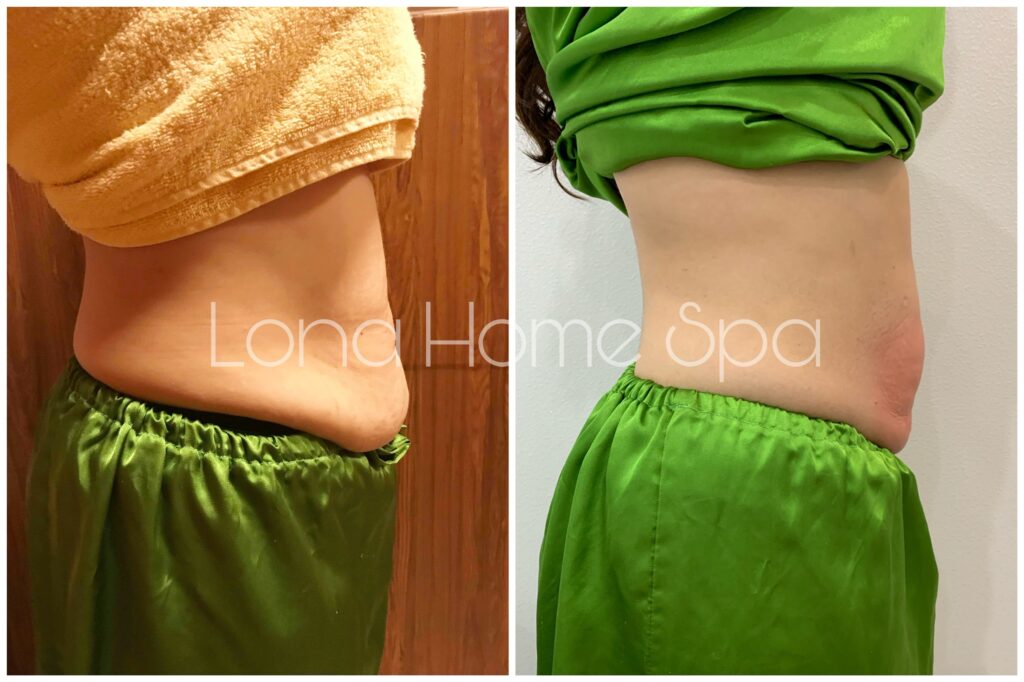 Hình ảnh trước và sau điều trị liệu pháp giảm béo tạo đường nét cơ thể – Từ khóa gốc: before_after, before_after_giam_beo_12.jpg, giam_beo.