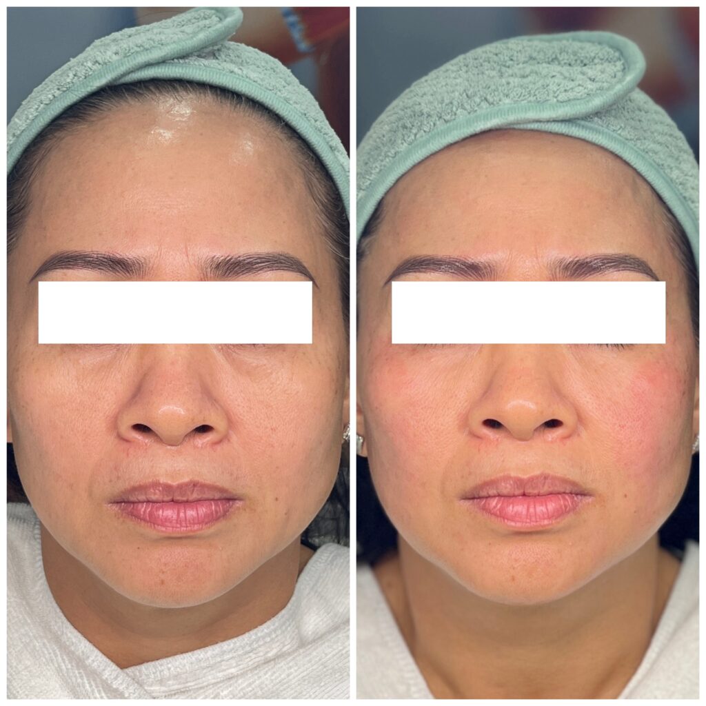 mặt nạ tightening Juliette Armand, mặt nạ nâng cơ Juliette Armand, mặt nạ phục hồi da sau HIFU, mặt nạ dưỡng ẩm Juliette Armand, mặt nạ chống lão hóa Juliette Armand