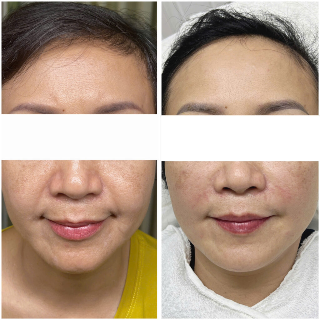 mặt nạ tightening Juliette Armand, mặt nạ nâng cơ Juliette Armand, mặt nạ phục hồi da sau HIFU, mặt nạ dưỡng ẩm Juliette Armand, mặt nạ chống lão hóa Juliette Armand