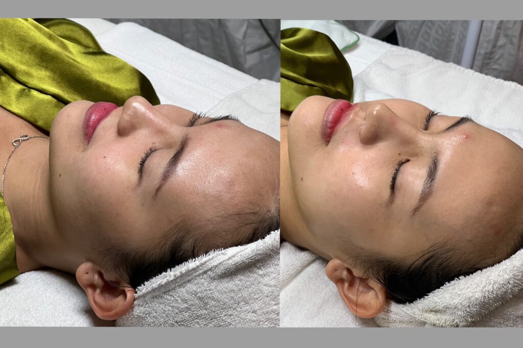 laser không hiệu quả, laser không hiệu quả, nguyên nhân laser không hiệu quả, trị liệu laser, cách cải thiện hiệu quả laser, Lona Skin Lab