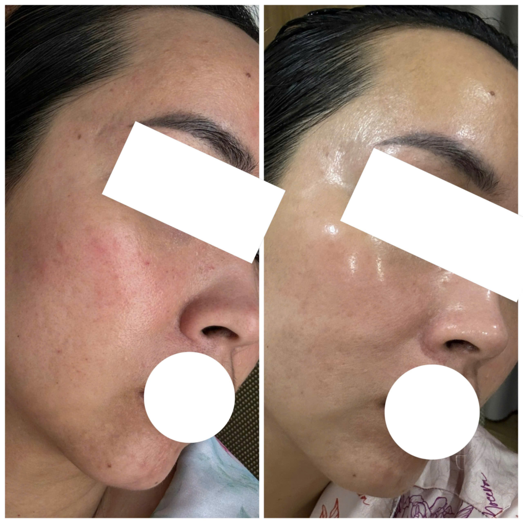 Bộ trị nám AiThan, trị nám da dầu, Bộ trị nám AiThan, giải pháp trị nám da nhờn, cách trị nám cho da dầu, sản phẩm trị nám cho da dầu