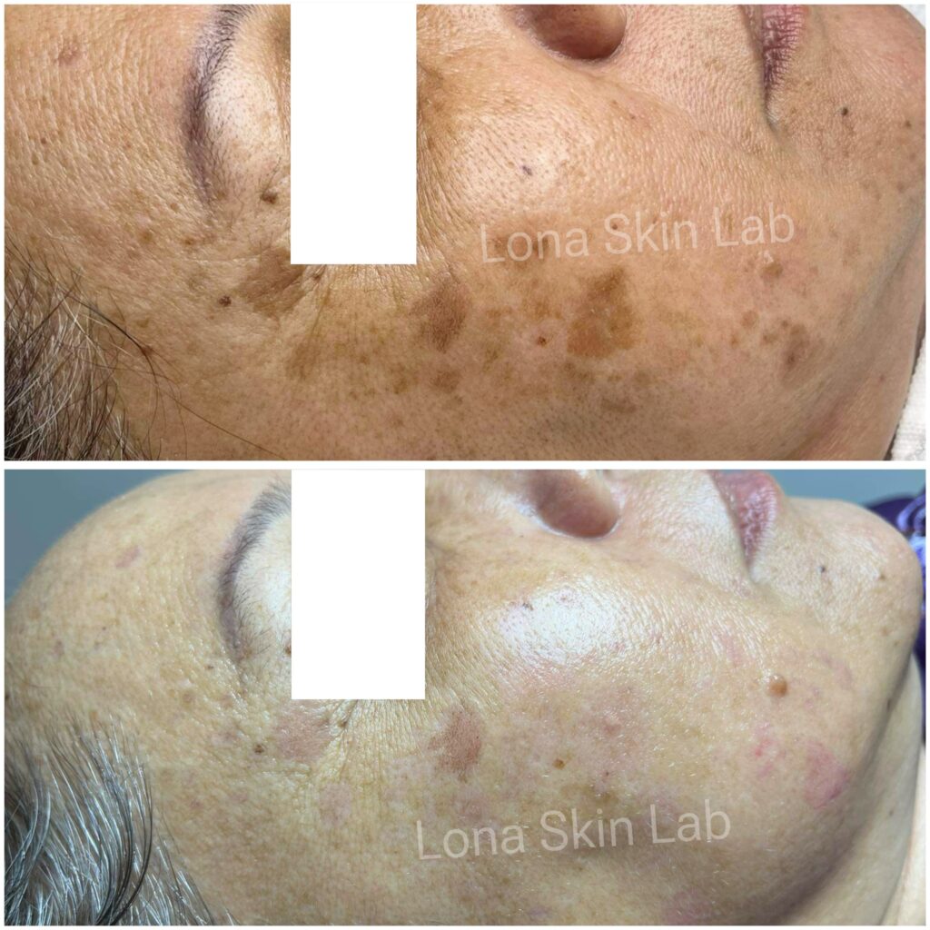 Trị mất sắc tố da, Rạn da trắng: Hình ảnh before & after điều trị laser