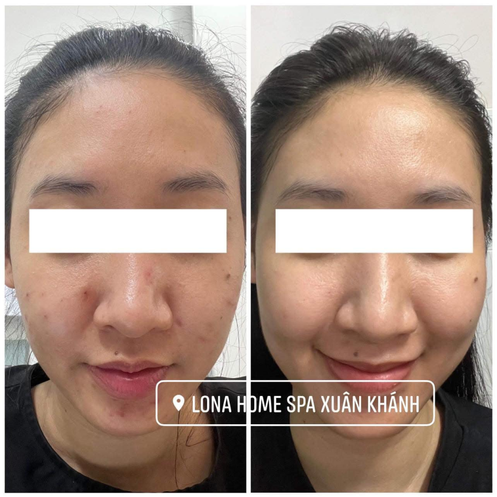 Pyruvic Acid Juliette Armand, Juliette Armand Pyruvic Acid, Pyruvic Acid trong chăm sóc da, Công dụng Pyruvic Acid, Hướng dẫn sử dụng Pyruvic Acid