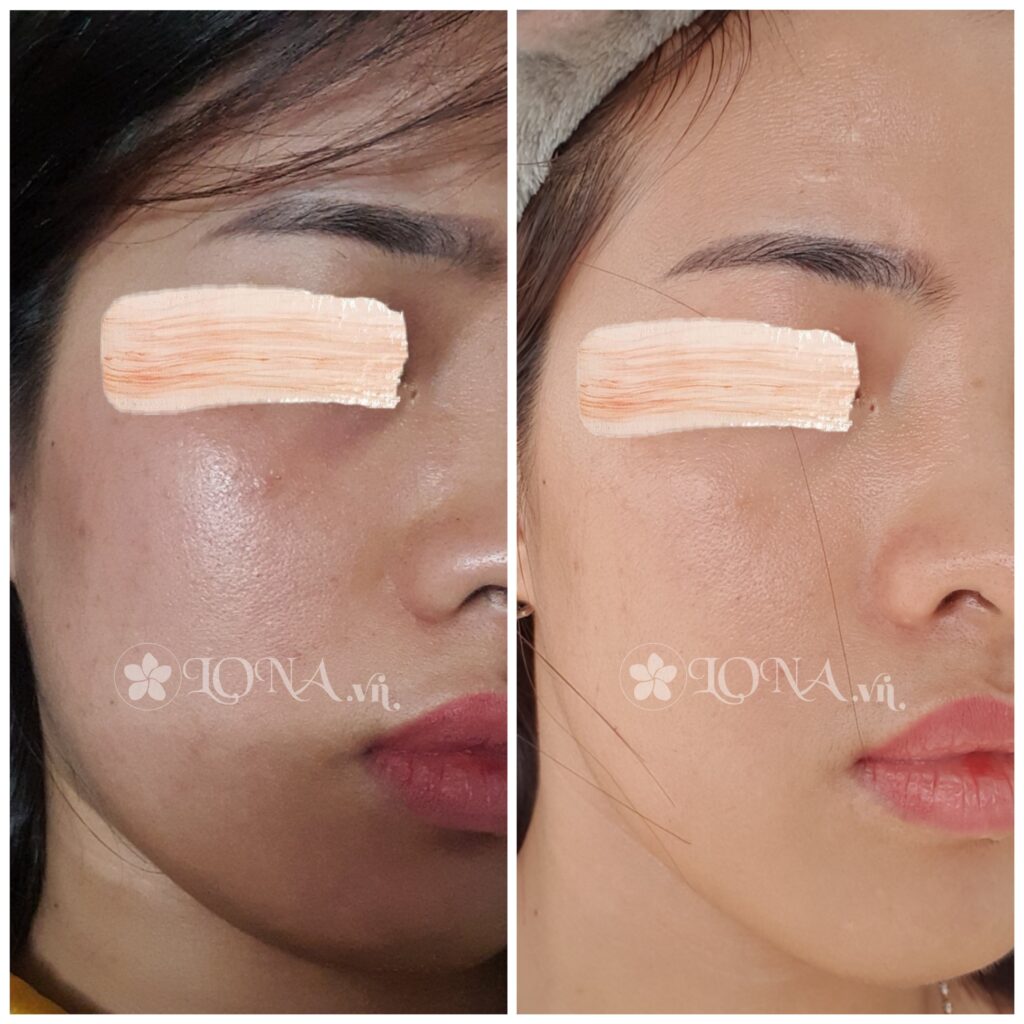 mesotherapy không hiệu quả, mesotherapy, tiêm meso, làm đẹp, tái tạo da, Lona Skin Lab