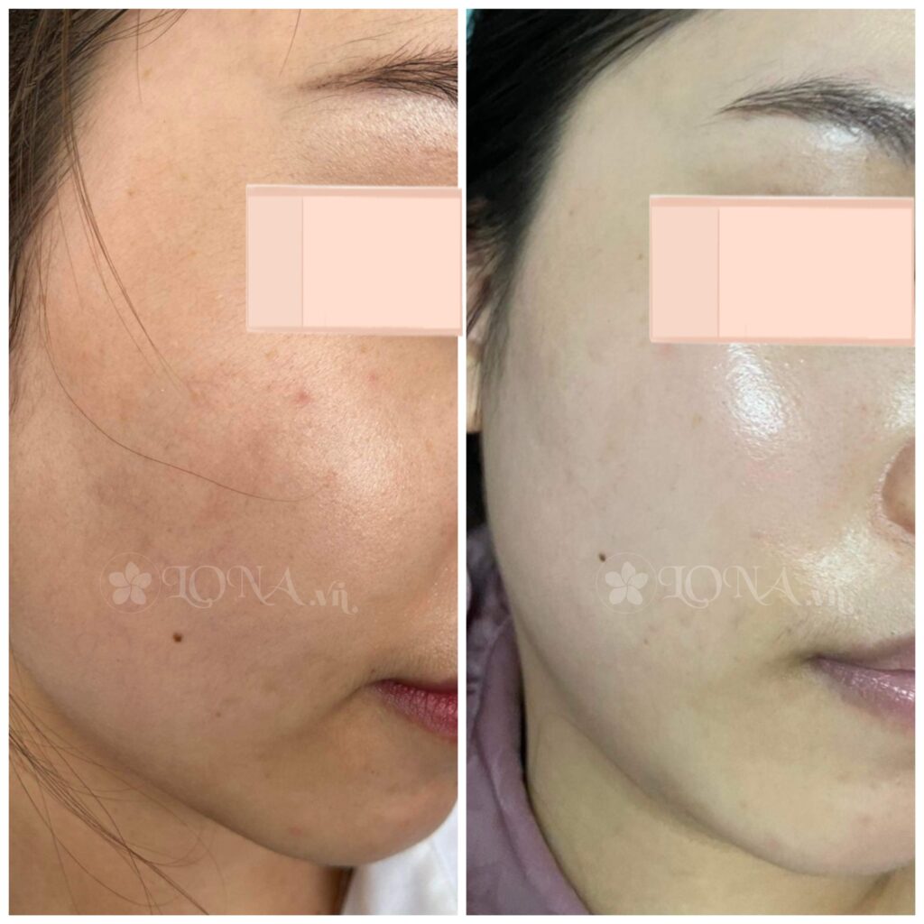Hình ảnh minh họa quá trình áp dụng Dermafirm Exosome đúng cách
