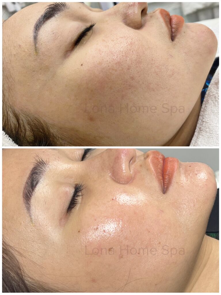 Hình ảnh trước và sau sử dụng Dermafirm Exosome cho thấy hiệu quả cải thiện da