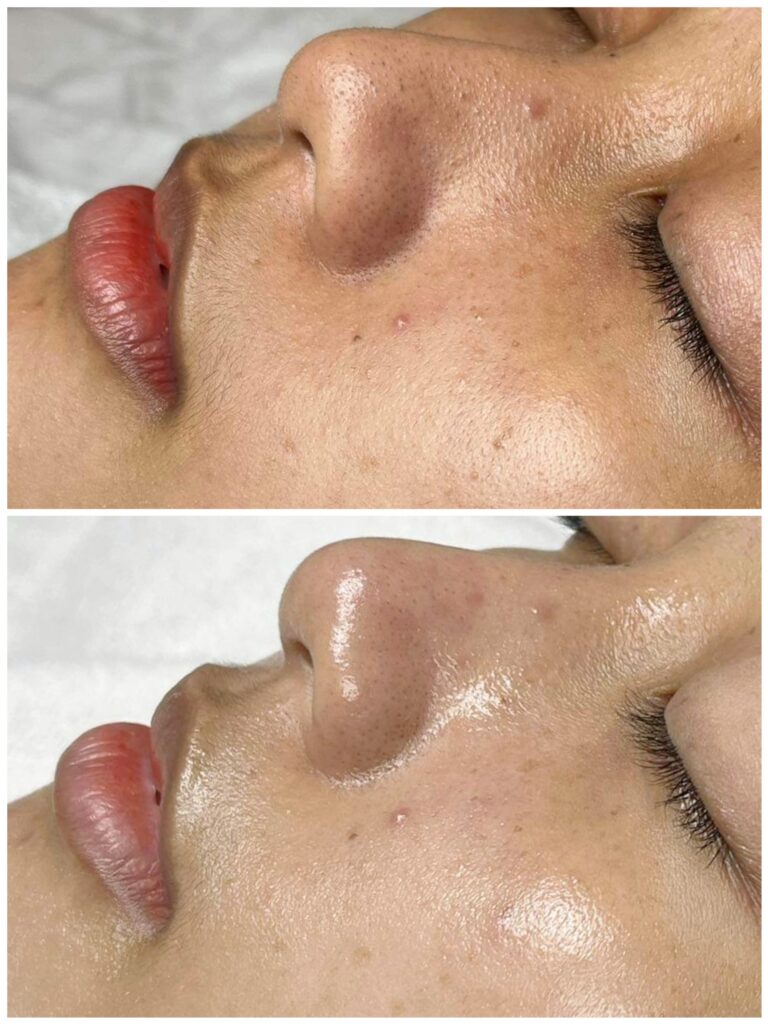ISOV sau peel, peel da xong nên dùng gì, chăm sóc da sau peel, sản phẩm dưỡng da sau peel, phục hồi da sau peel, ISOV chăm sóc da