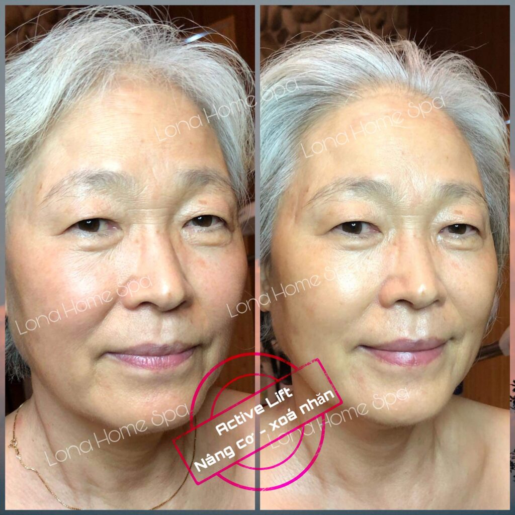 ISOV sau peel, peel da xong nên dùng gì, chăm sóc da sau peel, sản phẩm dưỡng da sau peel, phục hồi da sau peel, ISOV chăm sóc da