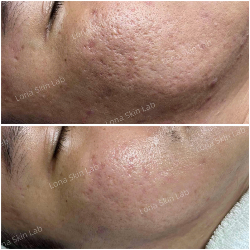 lỗ chân lông to và sẹo chân đinh, lỗ chân lông to, sẹo chân đinh, phân biệt lỗ chân lông và sẹo, điều trị da, Lona Skin Lab